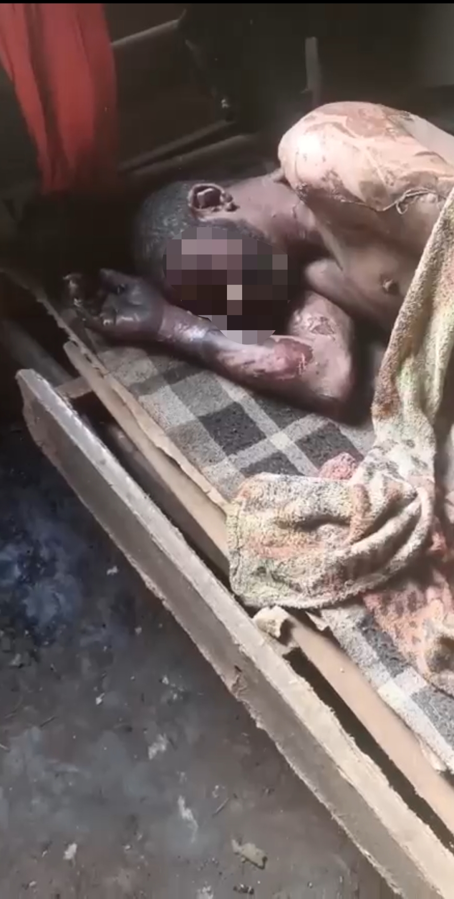 HOMEM SOFRE QUEIMADURAS EM CERCA DE 45% DO CORPO APÓS INCÊNDIO EM RESIDÊNCIA EM SÃO GONÇALO
